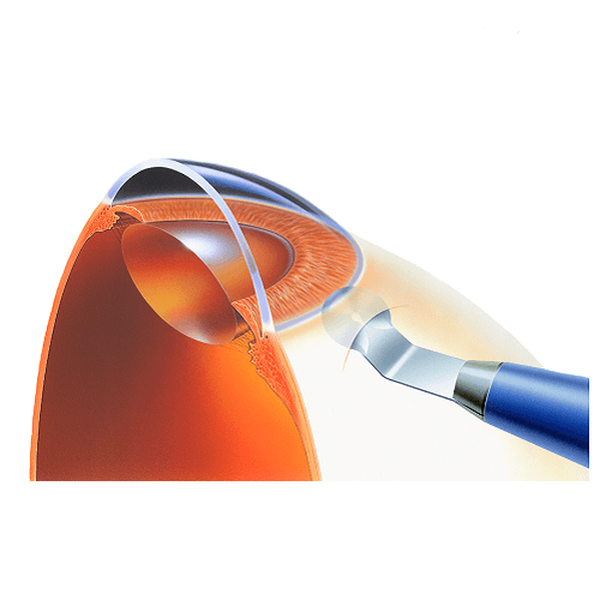 КРУГЛЫЙ СКАЛЬПЕЛЬ-РАССЛАИВАТЕЛЬ image