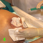 МЕТОДИКА НАЛОЖЕНИЯ ПОВЯЗКИ С ПРИМЕНЕНИЕМ СУПРАСОРБ CNP image