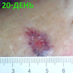 КЛИНИЧЕСКИЙ СЛУЧАЙ №5. ДИАБЕТИЧЕСКАЯ СТОПА image