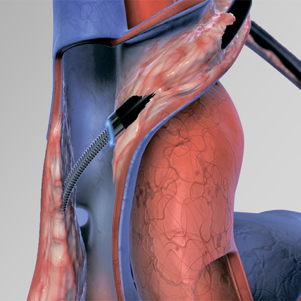 ЛАЗЕРНЫЙ КАТЕТЕР GLIDE LIGHT ДЛЯ УДАЛЕНИЯ ЭЛЕКТРОДОВ image