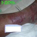 КЛИНИЧЕСКИЙ СЛУЧАЙ №3. ЯЗВА ГОЛЕНИ image