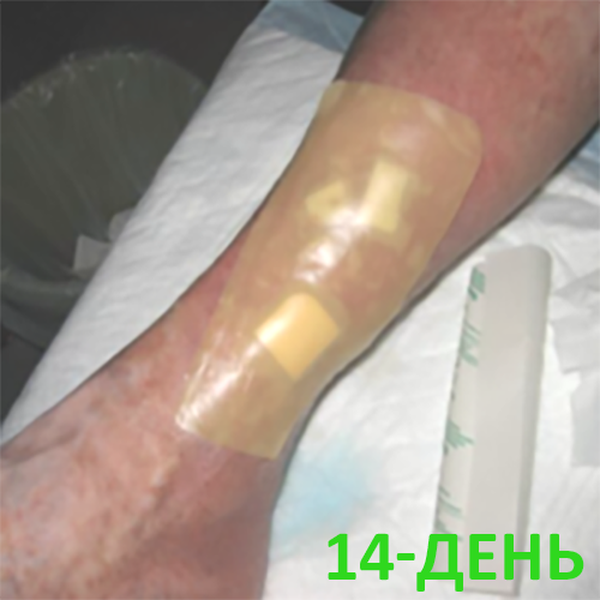 КЛИНИЧЕСКИЙ СЛУЧАЙ №2. ВЕНОЗНАЯ ЯЗВА image