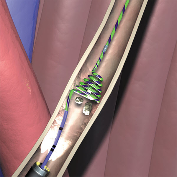 ЛОВУШКИ ДЛЯ ПРЕДОТВРАЩЕНИЯ МИГРАЦИИ КАМНЕЙ В МОЧЕТОЧНИКЕ STONE CONE image