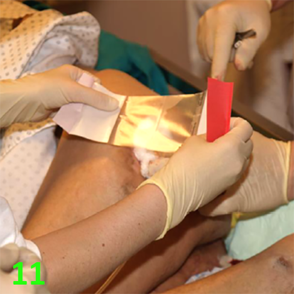 МЕТОДИКА НАЛОЖЕНИЯ ПОВЯЗКИ С ПРИМЕНЕНИЕМ СУПРАСОРБ CNP image