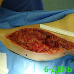 КЛИНИЧЕСКИЙ СЛУЧАЙ №3. ЗАЖИВЛЕНИЕ ВТОРИЧНЫМ НАТЯЖЕНИЕМ РАНА ПОСЛЕ АКШ image