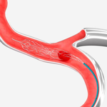 УСТРОЙСТВО ДЛЯ ВНУТРИСОСУДИСТОЙ ТРОМБОЭКТОМИИ EMBOTRAP III image