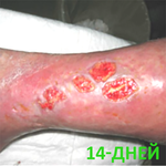 КЛИНИЧЕСКИЙ СЛУЧАЙ №2. ВЕНОЗНАЯ ЯЗВА image