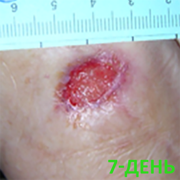 КЛИНИЧЕСКИЙ СЛУЧАЙ №5. ДИАБЕТИЧЕСКАЯ СТОПА image