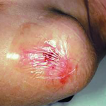 СУПРАСОРБ F (SUPRASORB F) ПЛЕНКА ЗАЩИТНАЯ image