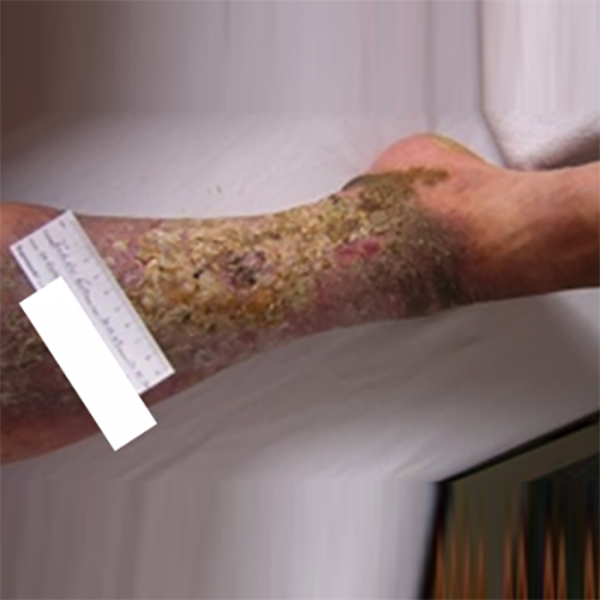 КЛИНИЧЕСКИЙ СЛУЧАЙ №3. ЯЗВА ГОЛЕНИ image