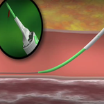 АНГИОСИЛ УСТРОЙСТВО ДЛЯ ЗАКРЫТИЯ ПУНКЦИИ (ANGIO-SEAL VIP) image