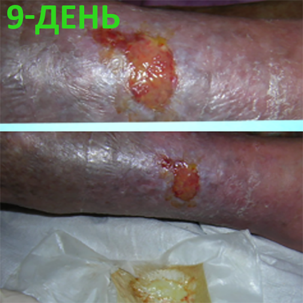 КЛИНИЧЕСКИЙ СЛУЧАЙ №4. ЯЗВА ГОЛЕНИ image