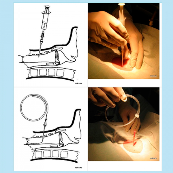 ДИЛЯТАЦИОННАЯ ТРАХЕОСТОМИЯ (РУКОВОДСТВО) image