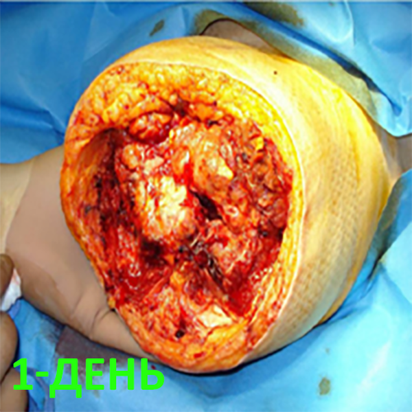 КЛИНИЧЕСКИЙ СЛУЧАЙ №1. ЭКЗАРТИКУЛЯЦИЯ С РЕВИЗИЕЙ КУЛЬТИ image