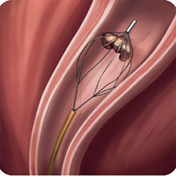 МУЛЬТИСТРУННАЯ КОНСТРУКЦИЯ ДЛЯ ИЗВЛЕЧЕНИЯ КАМНЕЙ LESLIE PARACHUTE image