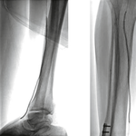 БАЛЛОННЫЙ КАТЕТЕР COYOTE НА СИСТЕМЕ ДОСТАВКИ ПО ПРОВОДНИКУ OTW (ПРОВОДНИК 0.014'') image