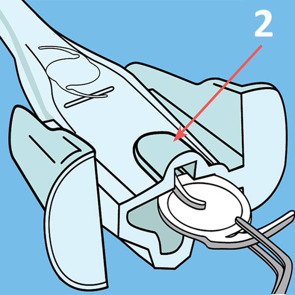 КАРТРИДЖИ ДЛЯ ВВЕДЕНИЯ ЛИНЗ image