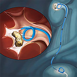 СТЕНТ МОЧЕТОЧНИКОВЫЙ УНИВЕРСАЛЬНОЙ ДЛИНЫ CONTOUR VL INJECTION image