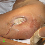 МЕТОДИКА НАЛОЖЕНИЯ ПОВЯЗКИ С ПРИМЕНЕНИЕМ СУПРАСОРБ CNP image