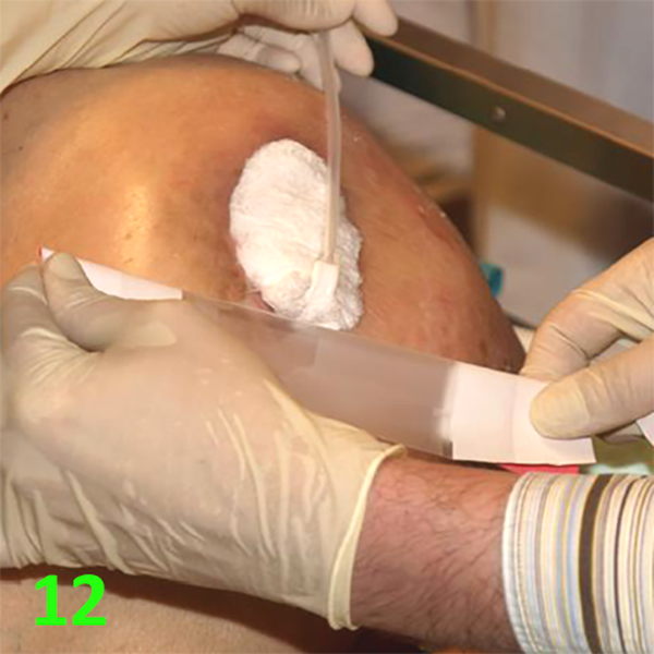 МЕТОДИКА НАЛОЖЕНИЯ ПОВЯЗКИ С ПРИМЕНЕНИЕМ СУПРАСОРБ CNP image