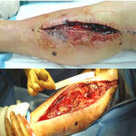 КЛИНИЧЕСКИЙ СЛУЧАЙ №3. ЗАЖИВЛЕНИЕ ВТОРИЧНЫМ НАТЯЖЕНИЕМ РАНА ПОСЛЕ АКШ image