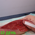 КЛИНИЧЕСКИЙ СЛУЧАЙ №3. ЗАЖИВЛЕНИЕ ВТОРИЧНЫМ НАТЯЖЕНИЕМ РАНА ПОСЛЕ АКШ image