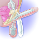 ПЕНИЛЬНЫЙ ИМПЛАНТ ТРЕХКОМПОНЕНТНЫЙ НАПОЛНЯЕМЫЙ AMS 700 image