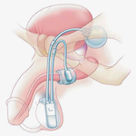 ИСКУССТВЕННЫЙ СФИНКТЕР МОЧЕВОГО ПУЗЫРЯ AMS 800 image