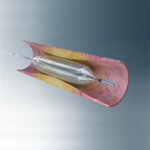 БАЛЛОННЫЙ КОРОНАРНЫЙ КАТЕТЕР ACCUFORCE image