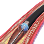 ЛАЗЕРНЫЙ КАТЕТЕР TURBO ELITE ДЛЯ ПЕРИФЕРИЧЕСКИХ АРТЕРИЙ image