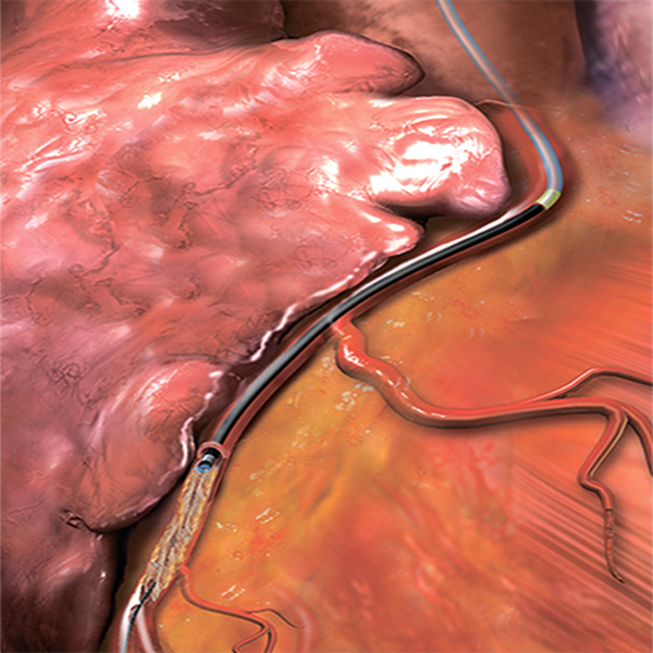 ЛАЗЕРНЫЙ КАТЕТЕР ELCA ДЛЯ КОРОНАРНЫХ АРТЕРИЙ image