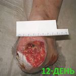 КЛИНИЧЕСКИЙ СЛУЧАЙ №2. ЗАЖИВЛЕНИЕ ВТОРИЧНЫМ НАТЯЖЕНИЕМ ПОСЛЕ АМПУТАЦИИ СТОПЫ image