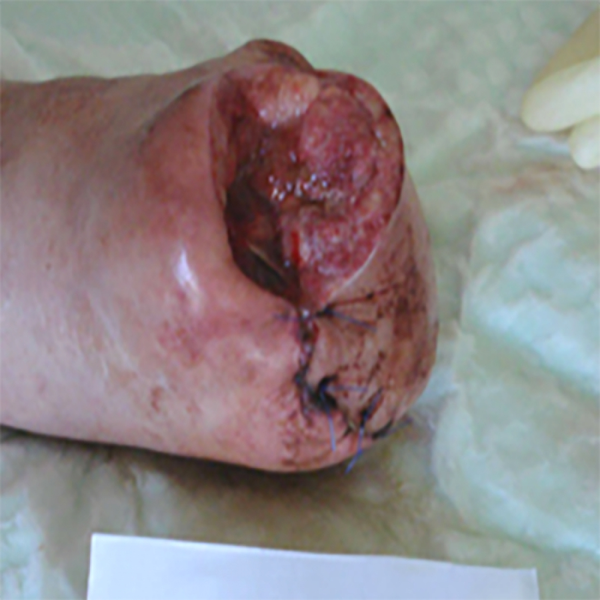 КЛИНИЧЕСКИЙ СЛУЧАЙ №2. ЗАЖИВЛЕНИЕ ВТОРИЧНЫМ НАТЯЖЕНИЕМ ПОСЛЕ АМПУТАЦИИ СТОПЫ image