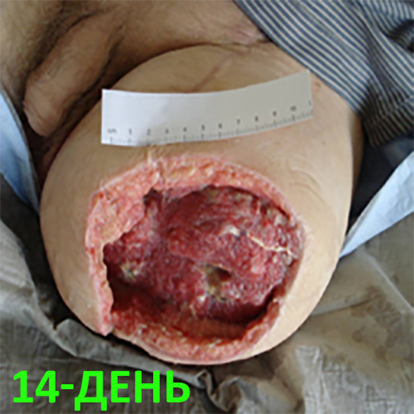 КЛИНИЧЕСКИЙ СЛУЧАЙ №1. ЭКЗАРТИКУЛЯЦИЯ С РЕВИЗИЕЙ КУЛЬТИ image