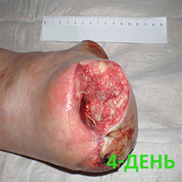 КЛИНИЧЕСКИЙ СЛУЧАЙ №2. ЗАЖИВЛЕНИЕ ВТОРИЧНЫМ НАТЯЖЕНИЕМ ПОСЛЕ АМПУТАЦИИ СТОПЫ image