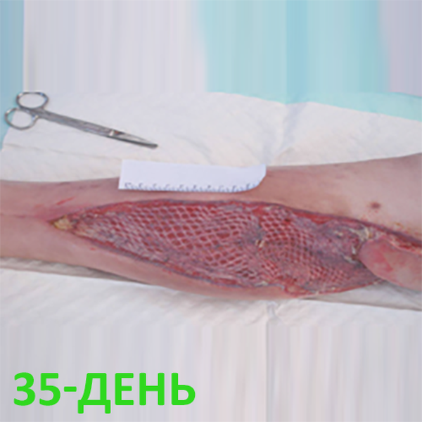 КЛИНИЧЕСКИЙ СЛУЧАЙ №3. ЗАЖИВЛЕНИЕ ВТОРИЧНЫМ НАТЯЖЕНИЕМ РАНА ПОСЛЕ АКШ image