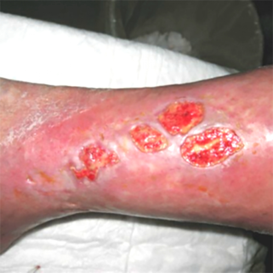 КЛИНИЧЕСКИЙ СЛУЧАЙ №2. ВЕНОЗНАЯ ЯЗВА