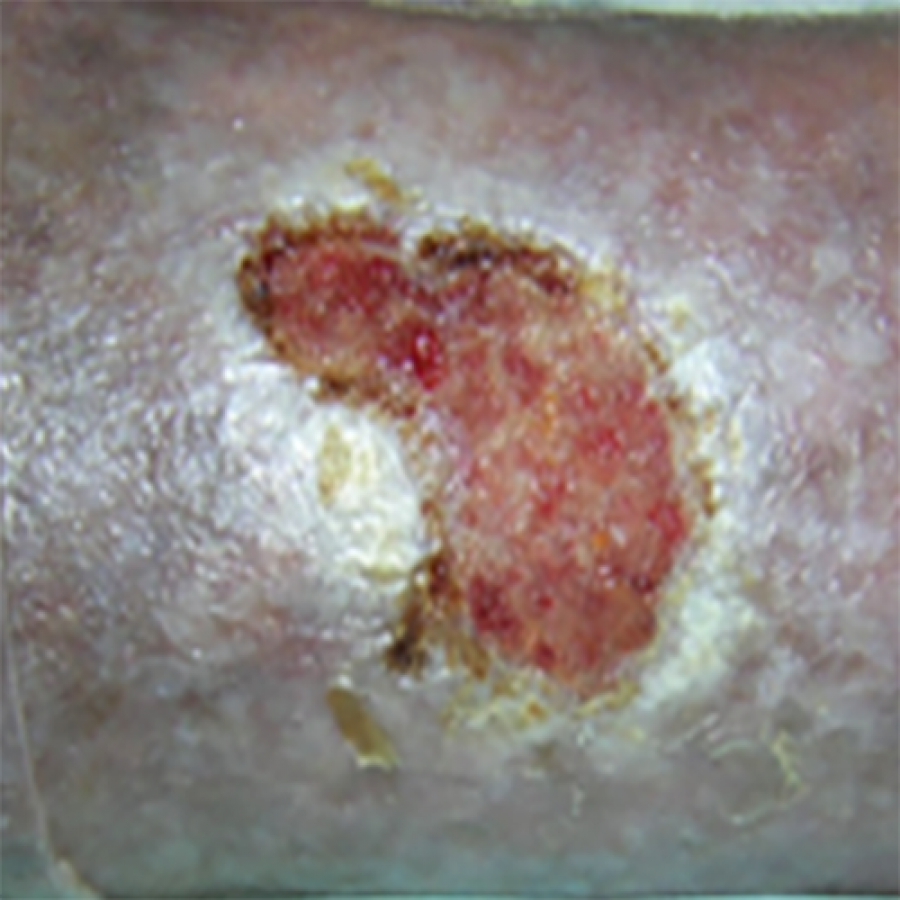 КЛИНИЧЕСКИЙ СЛУЧАЙ №4. ЯЗВА ГОЛЕНИ