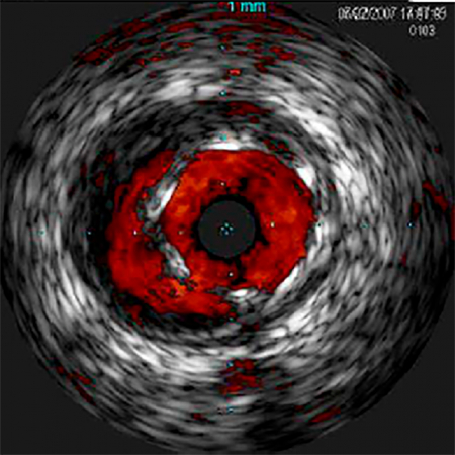 VOLCANO РЕЖИМ ВИЗУАЛИЗАЦИИ КРОВОТОКА CHROMAFLO ВСУЗИ