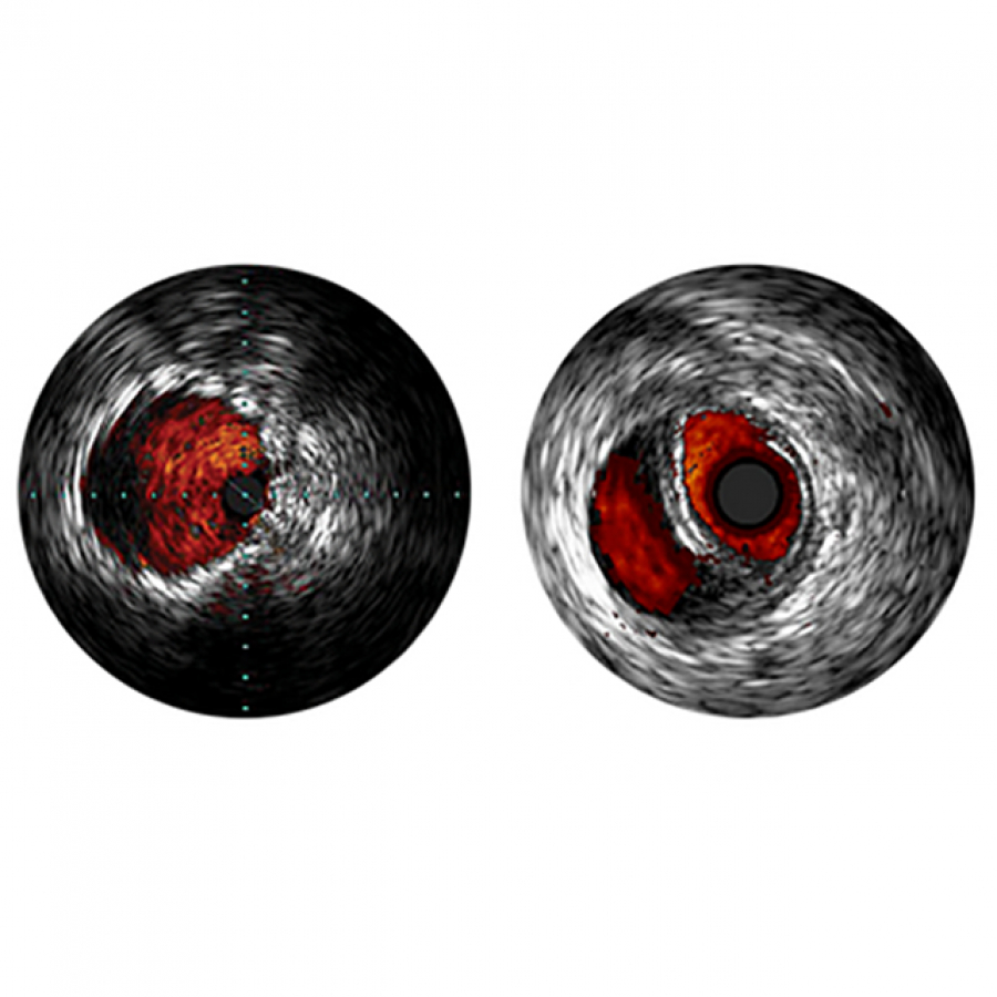 VOLCANO РЕЖИМ ВСУЗИ ЦИФРОВЫЕ КАТЕТЕРЫ EAGLE EYE ДЛЯ ПЕРИФЕРИЧЕСКИХ АРТЕРИЙ